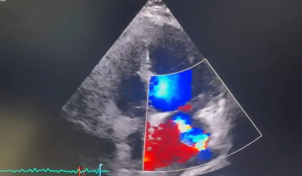POCUS Case: Severe Mitral Regurgitation Detected at the Bedside Following Pacemaker Lead Endocarditis
