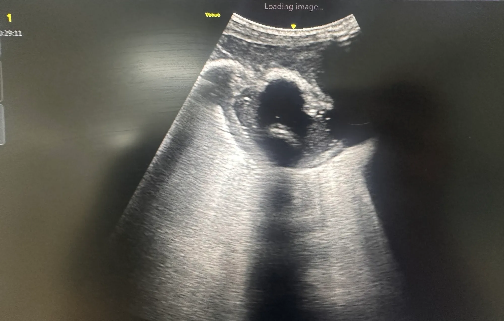 Ultrasound-Guided Aspiration
